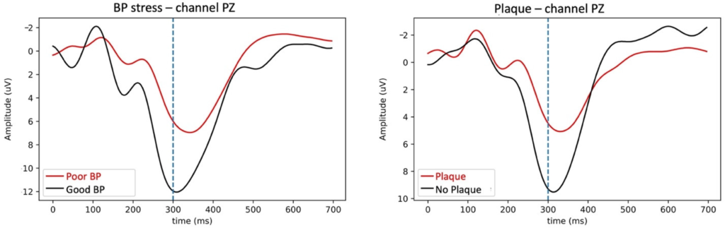 Comparative P300 waveforms illustrating variations in signal amplitude and timing across groups with differing cardiovascular profiles, including blood pressure status and plaque presence. These patterns highlight measurable differences in EEG-derived responses across populations.