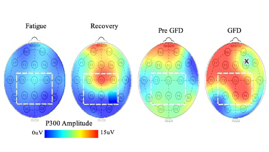Fatigue vs. Recovery EEG Topographs P300 latency (response timing) measured across age groups, showing changes from early adulthood through later life. The trend illustrates gradual differences in EEG-derived response timing over time, based on reference population data.